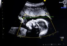 Ультразвуковий інструмент штучного інтелекту, схвалений FDA для підвищення точності виявлення аномалій плода